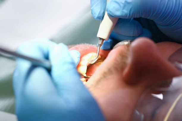 Best Emergency Wisdom Teeth Removal in Taylor Mill, KY